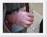 IMG_9995 * This guy showed up at the end of clinic without a number.  He asked if we had an injection for him.  I asked him why?  He took his hand out of his jacket and I understood why.  Somehow, he ended up with a severely infected had that was loosing skin due to so much swelling.  I didn't have an injection, but I gave him a course of some strong antibiotics. En pocas palabras, tiene una mano infectada, la cual Daniel reviso casi hasta al último de la clínica, ya que este hombre no tenia ni un número para revisarlo. * 3264 x 2448 * (2.28MB)