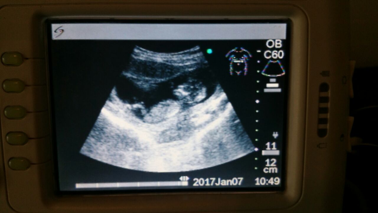 b170112 Ultrasound