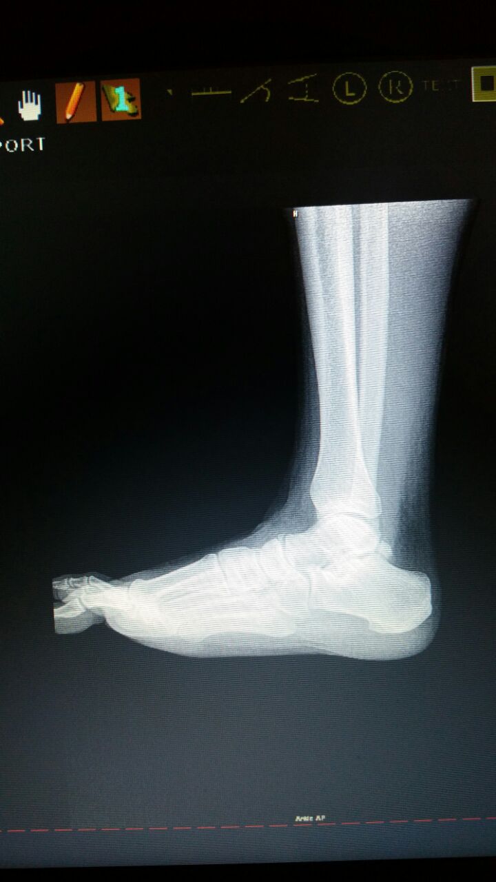 b180312 ankle